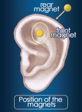 ZeroSmoke Ear Acupressure Therapy
